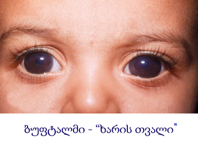 Анофтальм. Инфантильная глаукома. Врожденная глаукома буфтальм.