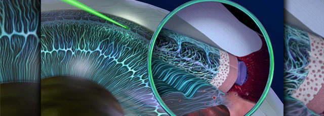 Glaucoma illustration