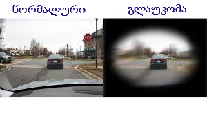 გლაუკომა სიმპტომები